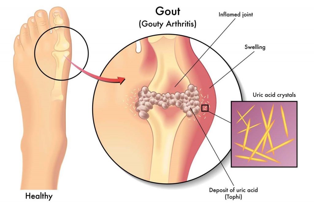 Bệnh gút (gout) có chữa khỏi hoàn toàn được không?
