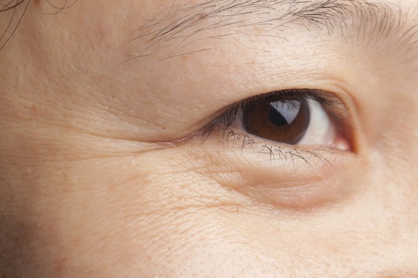 Bọng mắt dưới là gì? Nguyên nhân và cách chữa trị hiệu quả nhất -2